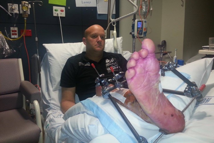 Derek Eady lies in a hospital bed with his cast-wrapped right foot elevated