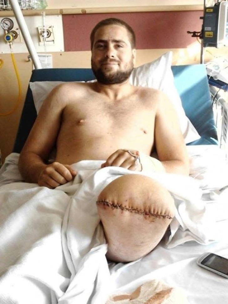 Cory McKinnon lying in a hospital bed with his amputated leg raised.